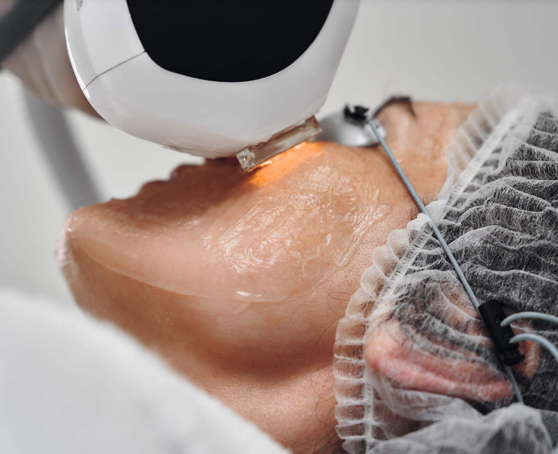 Laser resurfacing